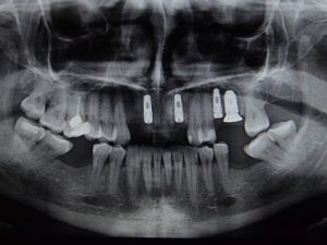 Панорамный снимок зубов в Жулебино